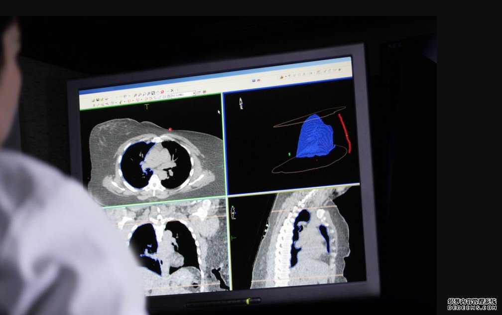 在美国杏耀挂机，州一级的肺癌筛查率与肺癌负担不一致